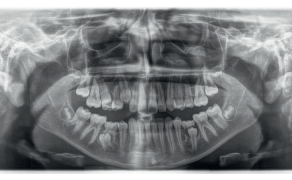 Ryc. 3a. Radiogramy przed leczeniem: a) pantomogram; b) cefalogram