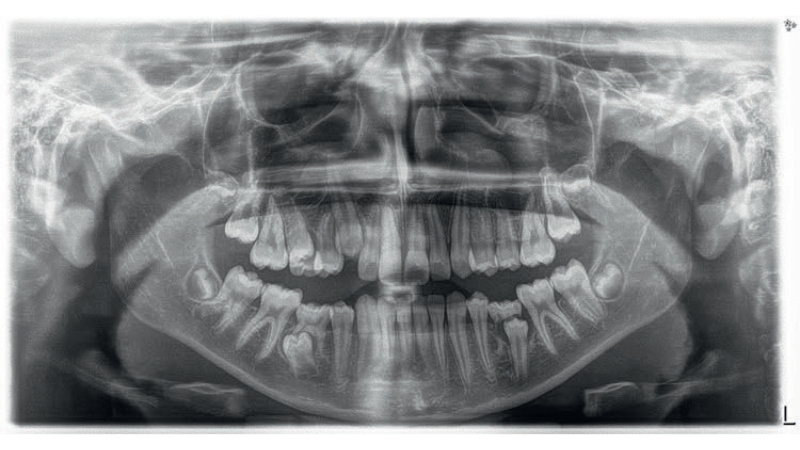 Ryc. 3a. Radiogramy przed leczeniem: a) pantomogram; b) cefalogram
