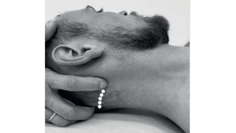 Fot. 8. Mobilizacje uciskowe kresy karkowej dolnej na przyczepie mięśni podpotylicznych; miejsca przyczepów zaznaczono kropkami (i jednocześnie miejsca wykonania mobilizacji uciskowych)