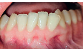 Fot. 4. Okolica 31-33 przed zabiegiem pogrubienia fenotypu dziąsłowego