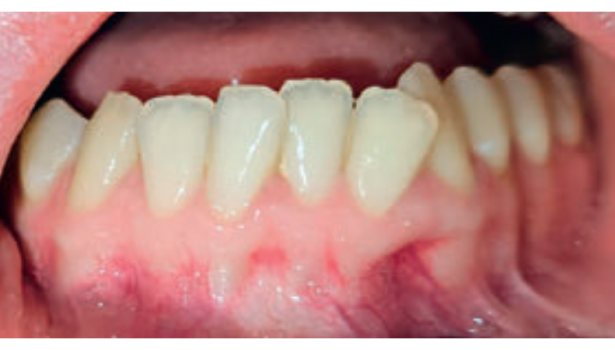 Fot. 4. Okolica 31-33 przed zabiegiem pogrubienia fenotypu dziąsłowego