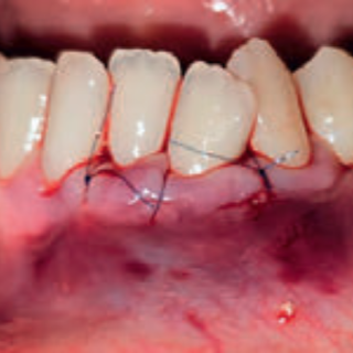 Fot. 6. Pogrubienie fenotypu z wykorzystaniem materiału Fibro-Gide