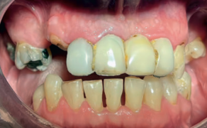 Fot. 4. Stan przed leczeniem protetycznym