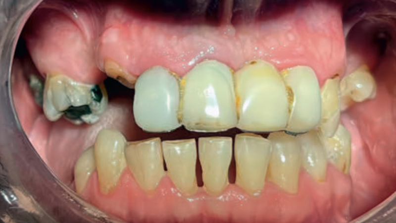 Fot. 4. Stan przed leczeniem protetycznym