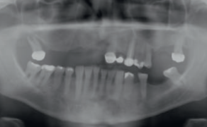 Fot. 2. Zdjęcie pantomograficzne przed leczeniem