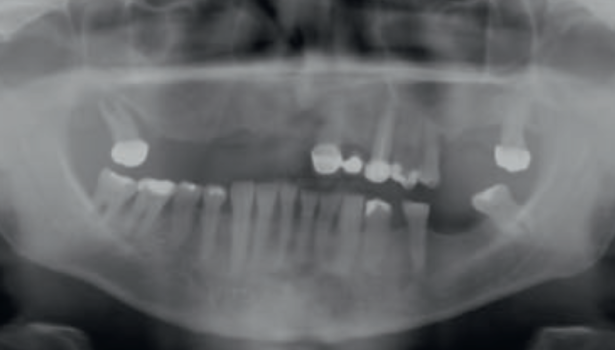 Fot. 2. Zdjęcie pantomograficzne przed leczeniem