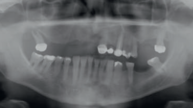 Fot. 2. Zdjęcie pantomograficzne przed leczeniem