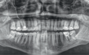 Ponowne leczenie endodontyczne