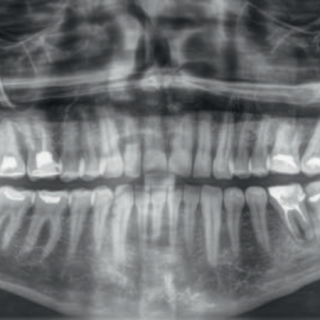 Ponowne leczenie endodontyczne