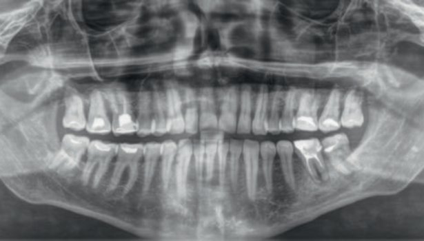 Ponowne leczenie endodontyczne