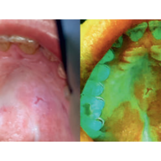Fot. 3. Widok błony śluzowej podniebienia twardego i miękkiego u pacjentki z rozpoznanym liszajem płaskim w świetle białym i świetle lasera 405 nm (wyraźnie widoczne ubytki autofluorescencyjne)