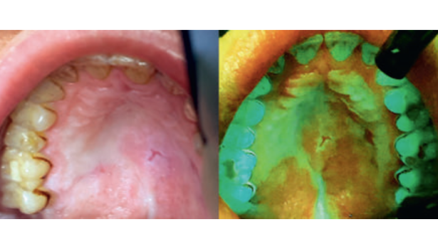 Fot. 3. Widok błony śluzowej podniebienia twardego i miękkiego u pacjentki z rozpoznanym liszajem płaskim w świetle białym i świetle lasera 405 nm (wyraźnie widoczne ubytki autofluorescencyjne)