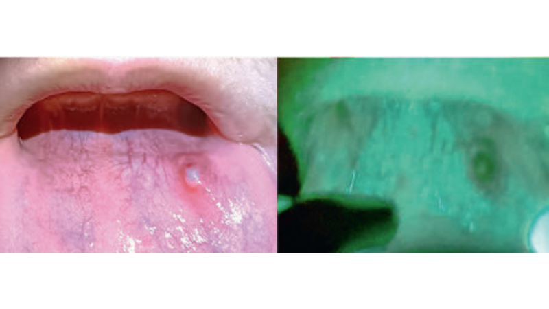 Fot. 5. Widok błony śluzowej wargi dolnej u pacjenta z rozpoznaną torbielą zastoinową w świetle białym i świetle lasera 405 nm (ubytek autofluorescencyjny spowodowany obecnością stanu zapalnego)