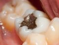 Amalgamat; fot. iStock