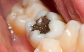 Amalgamat; fot. iStock