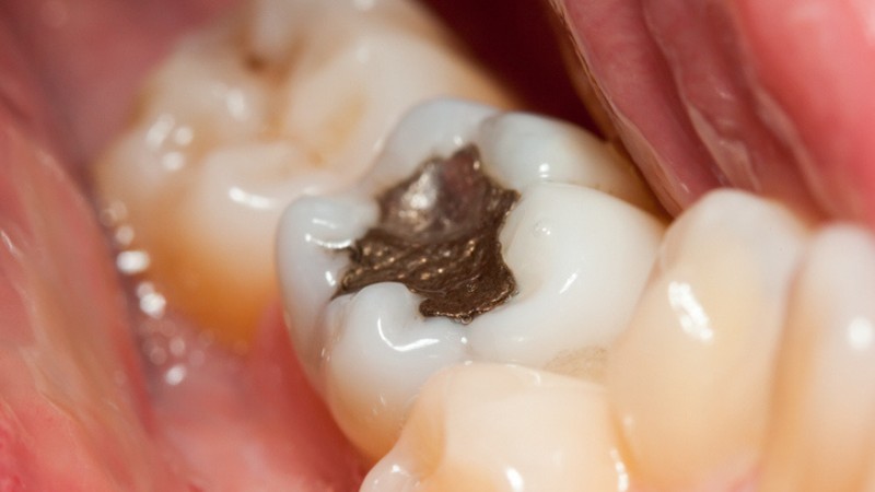 Amalgamat; fot. iStock