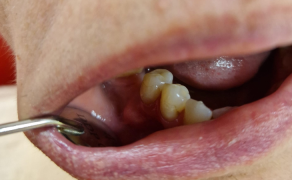 centralny włókniak