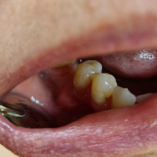 centralny włókniak