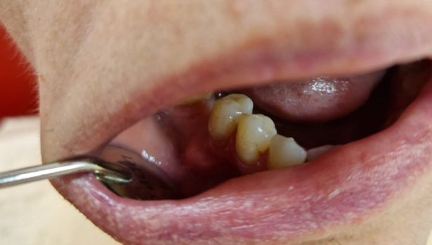 centralny włókniak