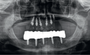 Fot. 34b. Sytuacja kliniczna po doszczepieniu implantów