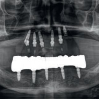 Fot. 34b. Sytuacja kliniczna po doszczepieniu implantów