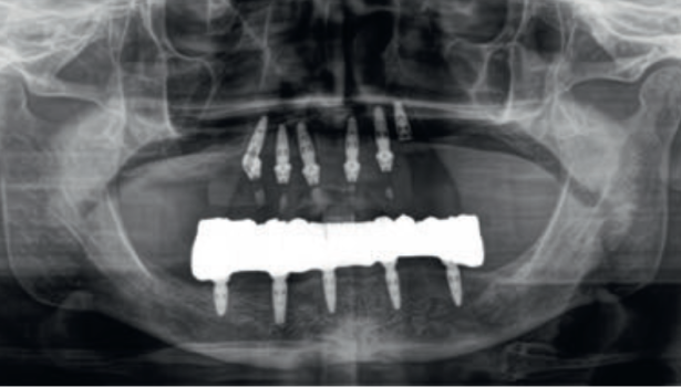 Fot. 34b. Sytuacja kliniczna po doszczepieniu implantów