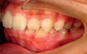 Fot. 1b. Zdjęcia wewnątrzustne przed leczeniem