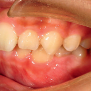 Fot. 1b. Zdjęcia wewnątrzustne przed leczeniem