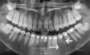 Fot. 11. Sześć miesięcy po odsłonięciu zęba wykonano nowe zdjęcie pantomograficzne. Na zdjęciu widoczny zakrzywiony korzeń zęba 34 (krótka strzałka), w okolicy okołowierzchołkowej nie widać oczywistych zaburzeń gęstości kości (długa strzałka)