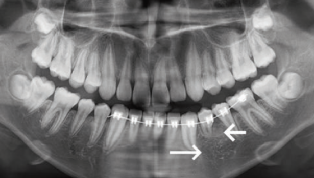 Fot. 11. Sześć miesięcy po odsłonięciu zęba wykonano nowe zdjęcie pantomograficzne. Na zdjęciu widoczny zakrzywiony korzeń zęba 34 (krótka strzałka), w okolicy okołowierzchołkowej nie widać oczywistych zaburzeń gęstości kości (długa strzałka)