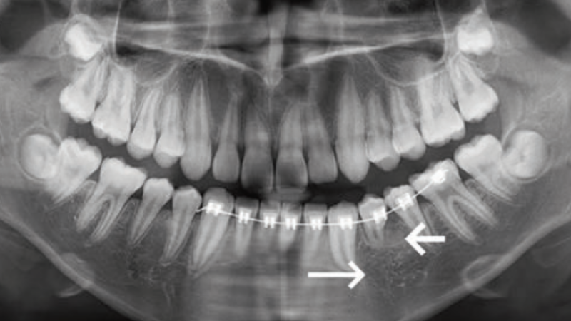 Fot. 11. Sześć miesięcy po odsłonięciu zęba wykonano nowe zdjęcie pantomograficzne. Na zdjęciu widoczny zakrzywiony korzeń zęba 34 (krótka strzałka), w okolicy okołowierzchołkowej nie widać oczywistych zaburzeń gęstości kości (długa strzałka)