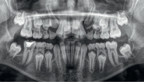 Ryc. 1. Początkowe OPG pacjentki S.J. Widoczne ostro odgraniczone przejaśnienia wokół wyrzynających się zębów 37 i 47, sięgające ich bifurkacji a odpowiadające torbielom erupcyjnym