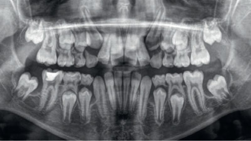 Ryc. 1. Początkowe OPG pacjentki S.J. Widoczne ostro odgraniczone przejaśnienia wokół wyrzynających się zębów 37 i 47, sięgające ich bifurkacji a odpowiadające torbielom erupcyjnym