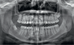 Ryc. 4. OPG pacjenta B.K. wykonane dwa lata po zabiegu usunięcia zęba 47