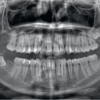 Ryc. 4. OPG pacjenta B.K. wykonane dwa lata po zabiegu usunięcia zęba 47