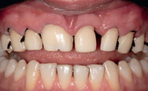 Ryc. 6. Preparacja zębów szczęki pod licówki ceramiczne z zastosowaniem techniki wstępnej tymczasowej oceny estetycznej (APT)