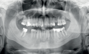 Leczenie endodontyczne pierwszego trzonowca żuchwy