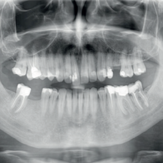 Leczenie endodontyczne pierwszego trzonowca żuchwy
