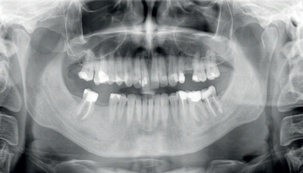 Leczenie endodontyczne pierwszego trzonowca żuchwy