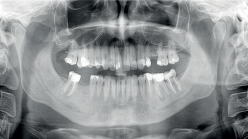 Leczenie endodontyczne pierwszego trzonowca żuchwy