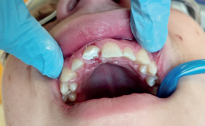 Jednowizytowe leczenie skomplikowanego złamania korony zęba 11 u 16-latka