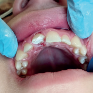 Jednowizytowe leczenie skomplikowanego złamania korony zęba 11 u 16-latka