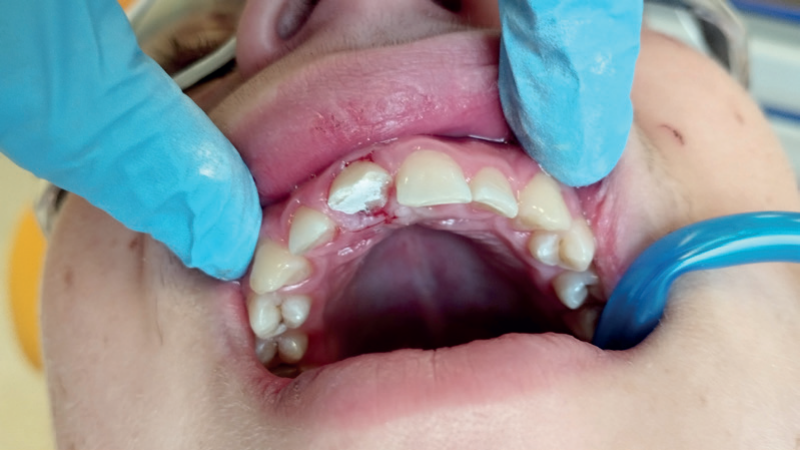 Jednowizytowe leczenie skomplikowanego złamania korony zęba 11 u 16-latka