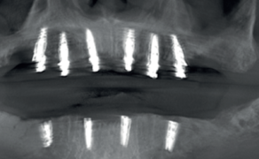 pełnołukowe obciążenie natychmiastowe