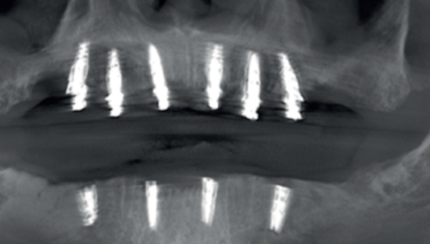 pełnołukowe obciążenie natychmiastowe