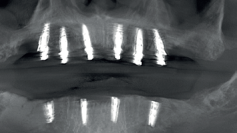 pełnołukowe obciążenie natychmiastowe