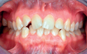 prewencja próchnicy i zapaleń dziąseł