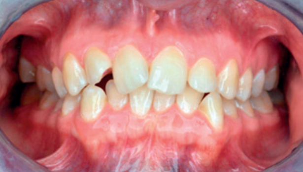 prewencja próchnicy i zapaleń dziąseł