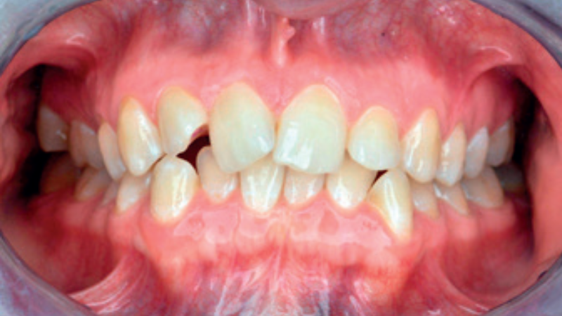 prewencja próchnicy i zapaleń dziąseł