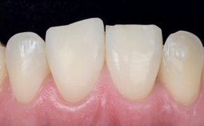 Fot. 1. Sytuacja wyjściowa. Widoczne skrócenie i nierówność brzegów siecznych zębów górnych